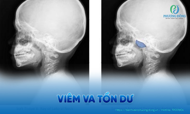 Viêm VA tồn dư: Nguyên nhân, biến chứng và điều trị
