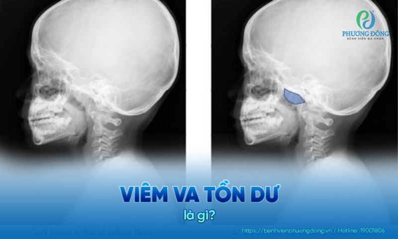 Viêm VA tồn dư là tình trạng viêm VA tiến triển do không được điều trị