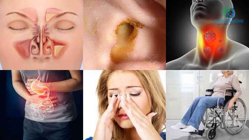 Nhóm biến chứng nguy hiểm tầm ẩn khi viêm VA không được điều trị dứt điểm