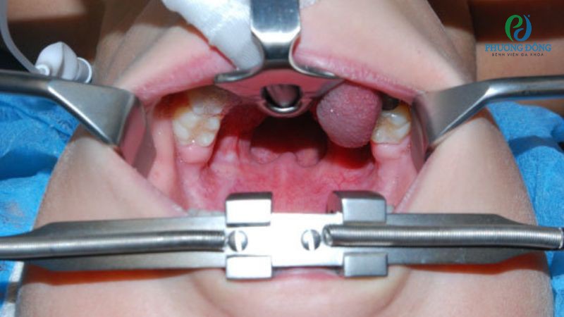 Can thiệp ngoại khoa viêm VA tại cơ sở y tế uy tín