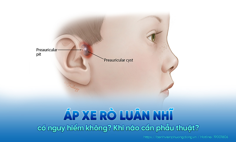 Áp xe rò luân nhĩ có nguy hiểm không? Khi nào cần phẫu thuật?
