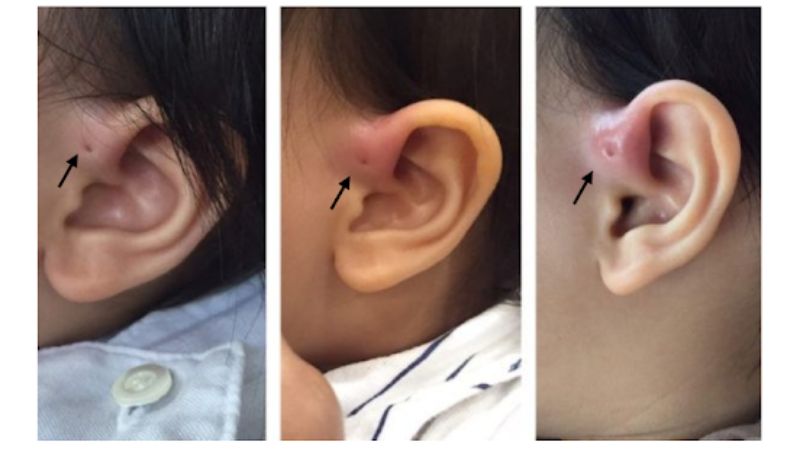 Các hành động cào, gãi, nặn ở lồ rò luân nhĩ có thể khiến khu vực này sưng lên và tăng nguy cơ bị áp xe