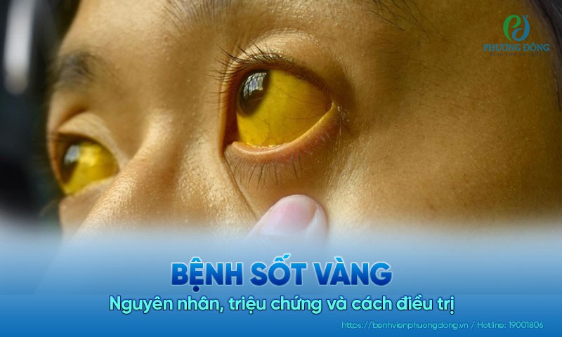 Bệnh sốt vàng: Nguyên nhân, triệu chứng và cách điều trị