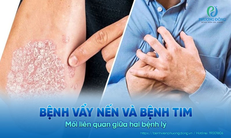 Tìm hiểu về mối liên quan giữa bệnh vẩy nến và bệnh tim