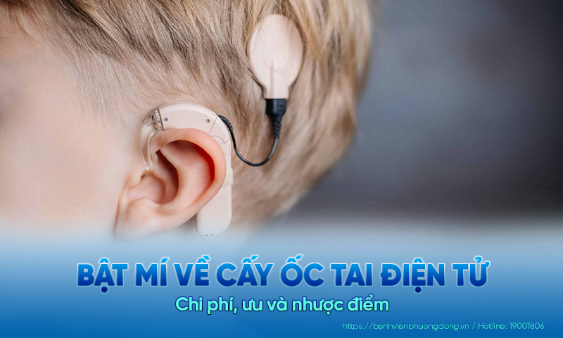Bật mí về cấy ốc tai điện tử: Chi phí, ưu và nhược điểm