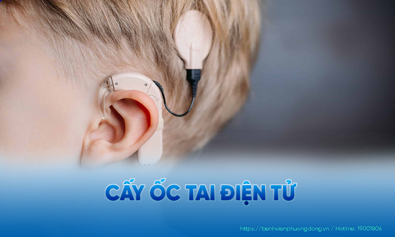 Cấu tạo của ốc tai điện tử khá phức tạp với các bộ phận khác nhau