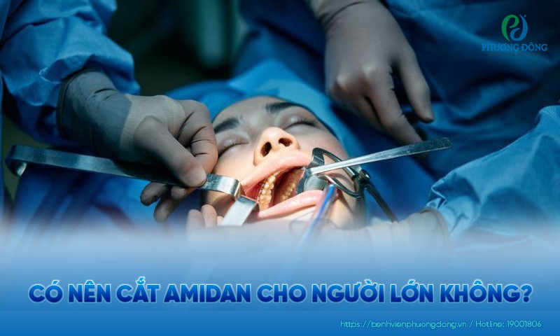Có nên cắt amidan cho người lớn không? Ai nên và không nên cắt?