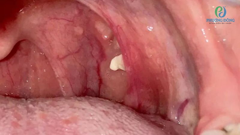 Một số trường hợp chống chỉ định cắt amidan