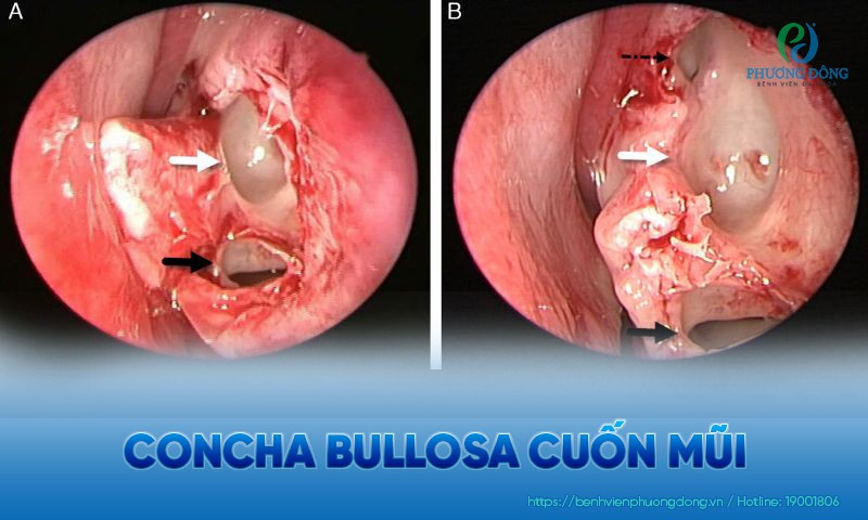 Concha Bullosa cuốn mũi: Triệu chứng, nguyên nhân và điều trị