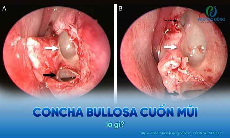 Concha Bullosa cuốn mũi là tình trạng túi khí trong cuốn mũi phát triển quá mức