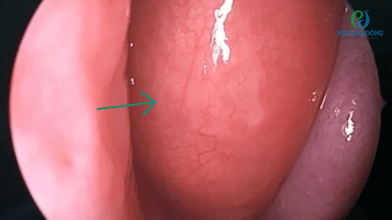 Đề phòng với những biến chứng Concha Bullosa cuốn mũi