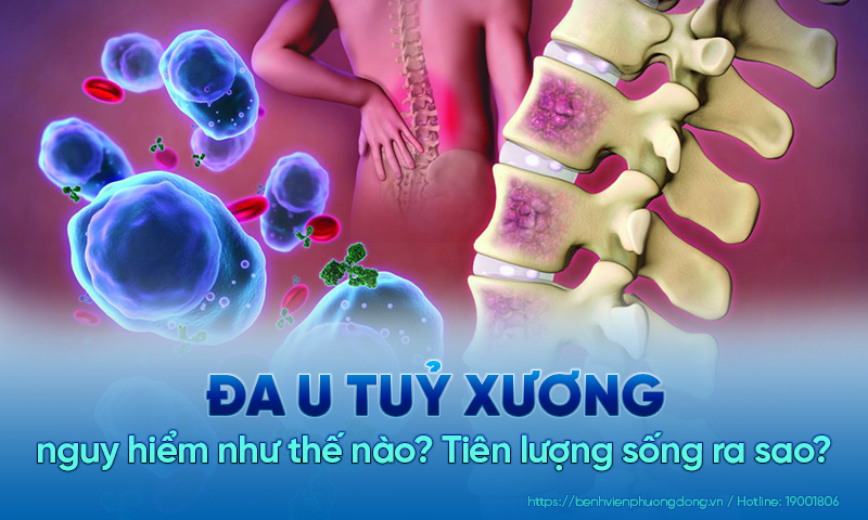 Đa u tủy xương nguy hiểm như thế nào? Tiên lượng sống ra sao?