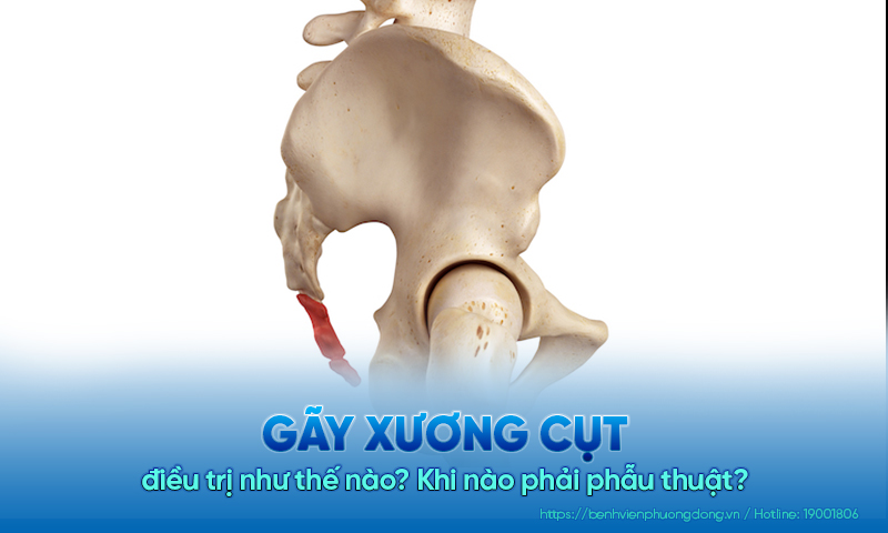 Gãy xương cụt điều trị như thế nào? Khi nào phải phẫu thuật?