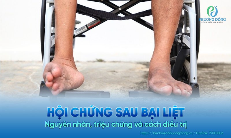 Hội chứng sau bại liệt: Nguyên nhân, triệu chứng và cách điều trị