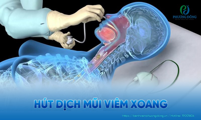 Hút dịch mũi viêm xoang: Khi nào nên hút và quy trình thực hiện