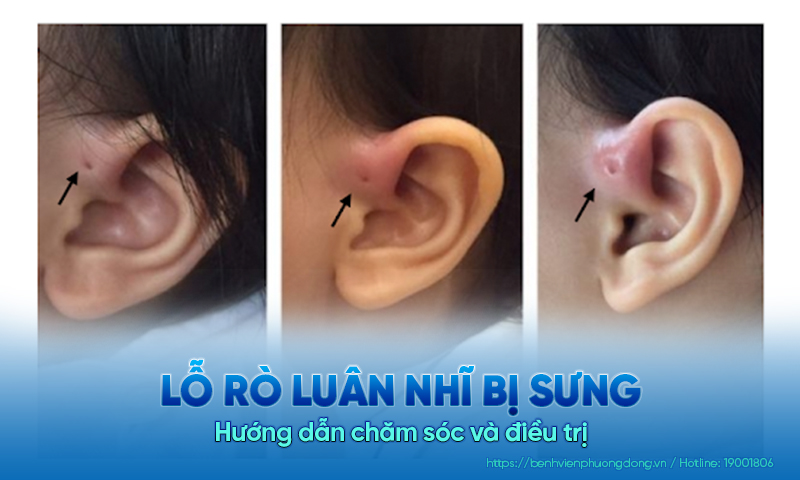 Lỗ rò luân nhĩ bị sưng: Hướng dẫn chăm sóc và điều trị