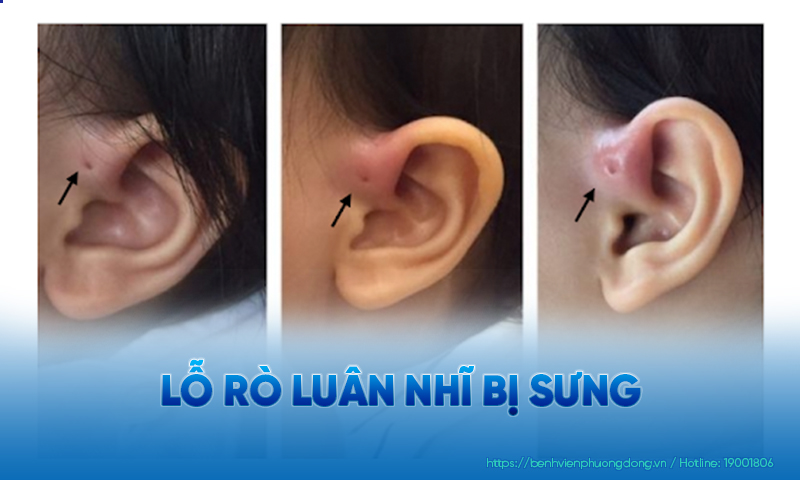 Tình trạng sưng lỗ rò luân nhĩ nên được xử lý sớm