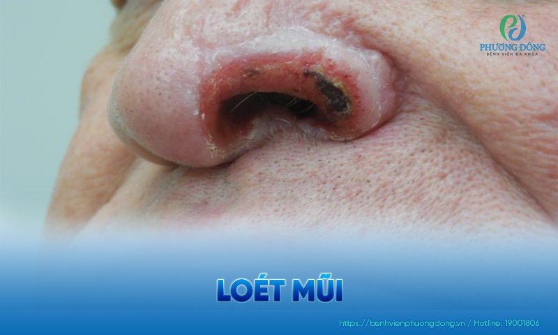 Loét mũi là gì? 12 nguyên nhân gây bệnh cần lưu tâm