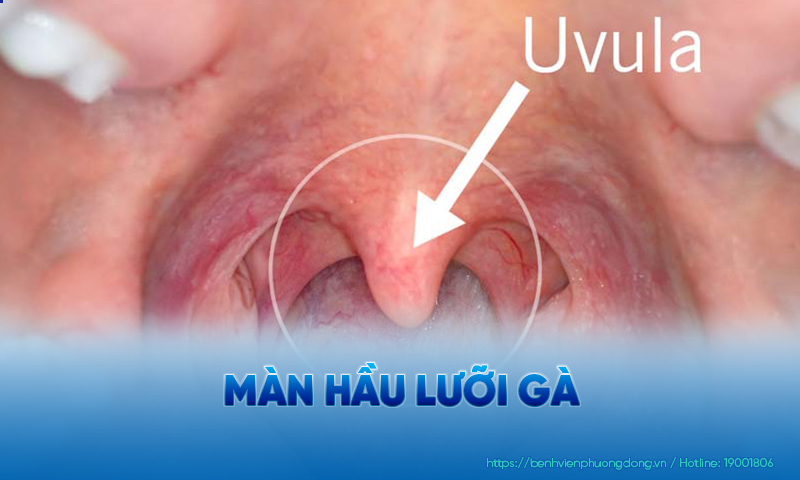 Minh hoạ màn hầu lưỡi gà