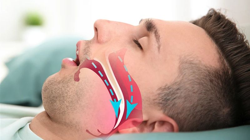 Các bất thường ở bộ phận này có thể khiến người bệnh ngưng thở khi ngủ