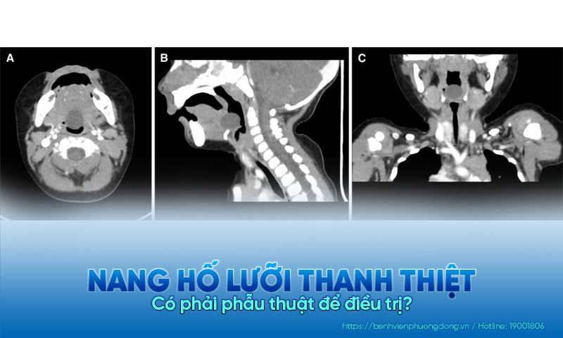 Nang hố lưỡi thanh nhiệt: Có phải phẫu thuật để điều trị?