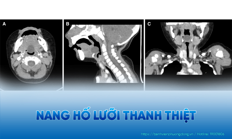 Hình chụp nang hố lưỡi thanh thiệt trên máy CT (khối u có kích thước 14x16mm)