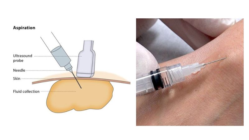 Với các nang có kích thước nhỏ, bác sĩ sẽ dùng kim chọc và hút dịch ra ngoài