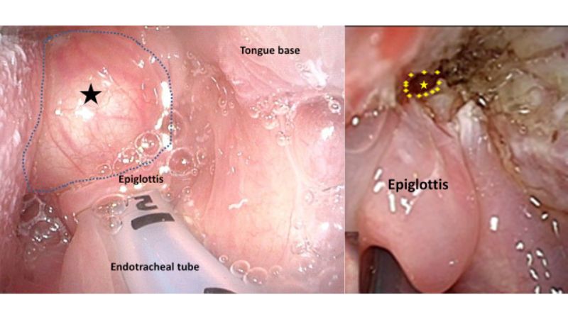 Nang nhầy gốc lưỡi trước (hình trái) và sau khi loại bỏ (hình sao)(hình phải)