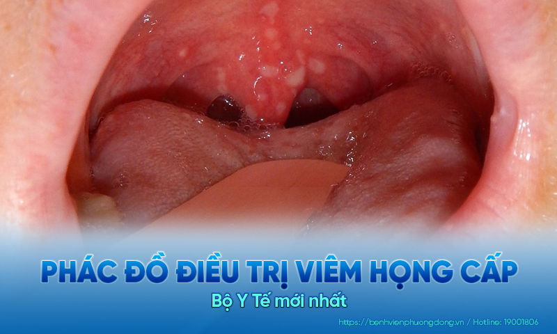 Phác đồ điều trị viêm họng cấp Bộ Y Tế mới nhất