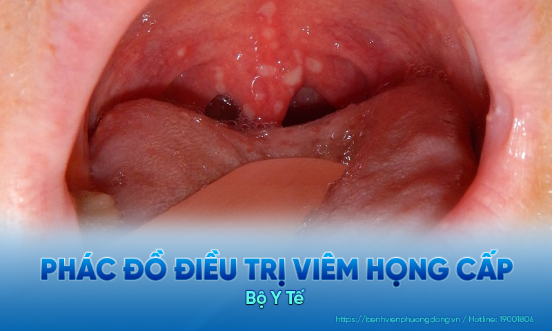 Hiện nay đã có phác đồ điều trị viêm họng cấp do Bộ Y Tế đưa ra
