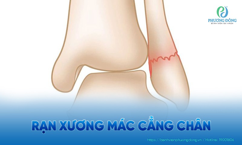 Rạn xương mác cẳng chân: Nguyên nhân, triệu chứng và điều trị