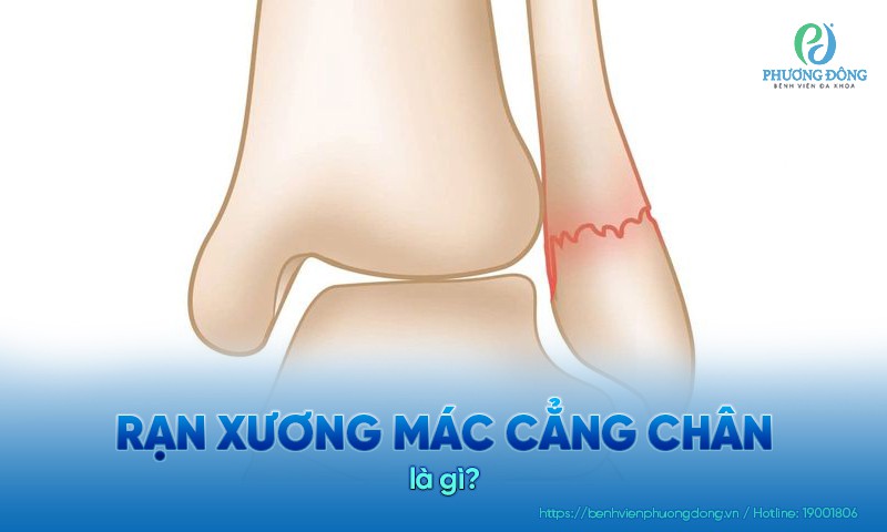 Rạn xương mác cẳng chân là tình trạng tổn thương xương nhẹ