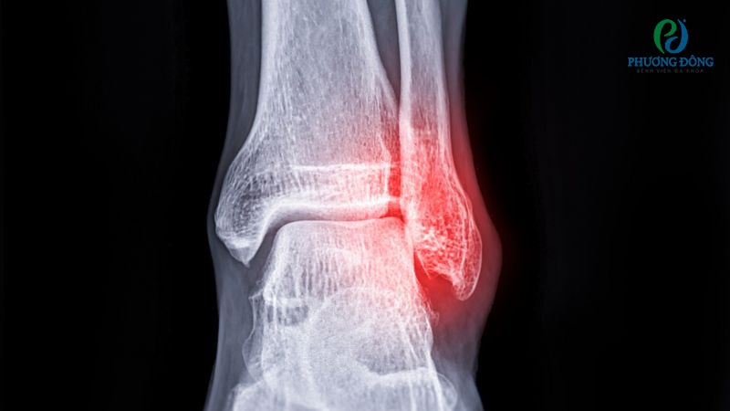 Rạn xương mác cần được điều trị sớm phòng ngừa các biến chứng nguy hiểm