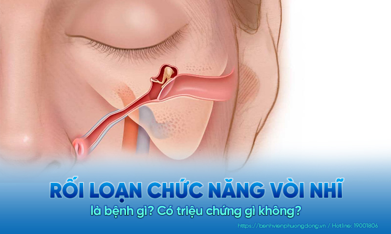 Rối loạn chức năng vòi nhĩ là bệnh gì? Có triệu chứng gì không?