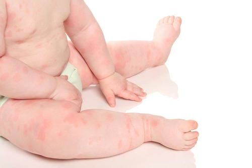 Hiện tượng trẻ bị dị ứng đạm bò khi lựa chọn sữa không phù hợp