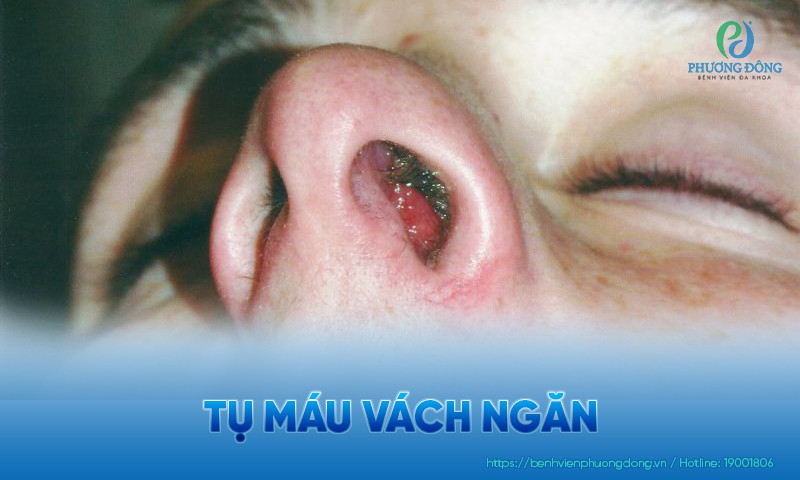 Tụ máu vách ngăn: Triệu chứng, nguyên nhân và hướng điều trị