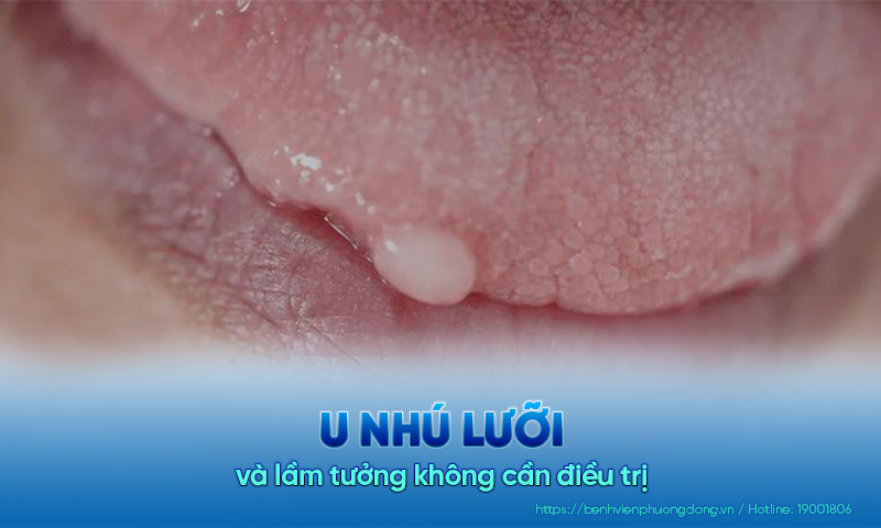 U nhú lưỡi và lầm tưởng không cần điều trị, bệnh tự khỏi!