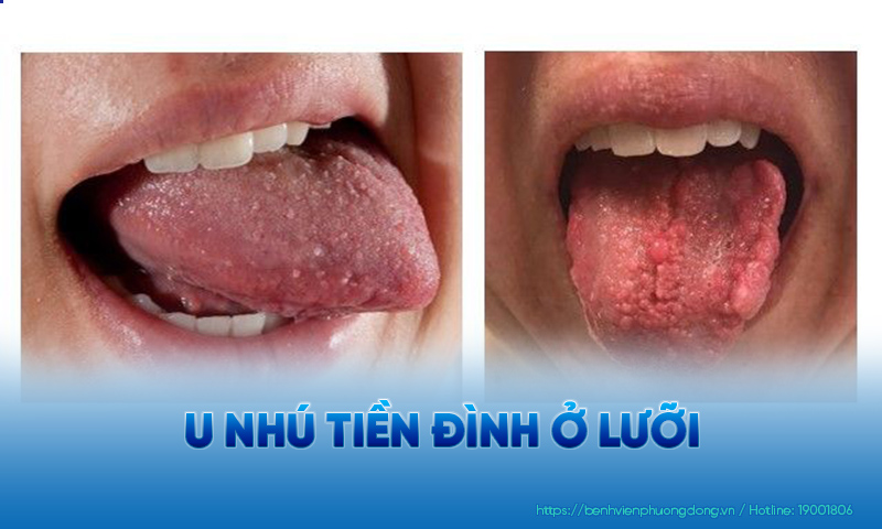 Minh hoạ hình ảnh u nhú tiền đình ở lưỡi