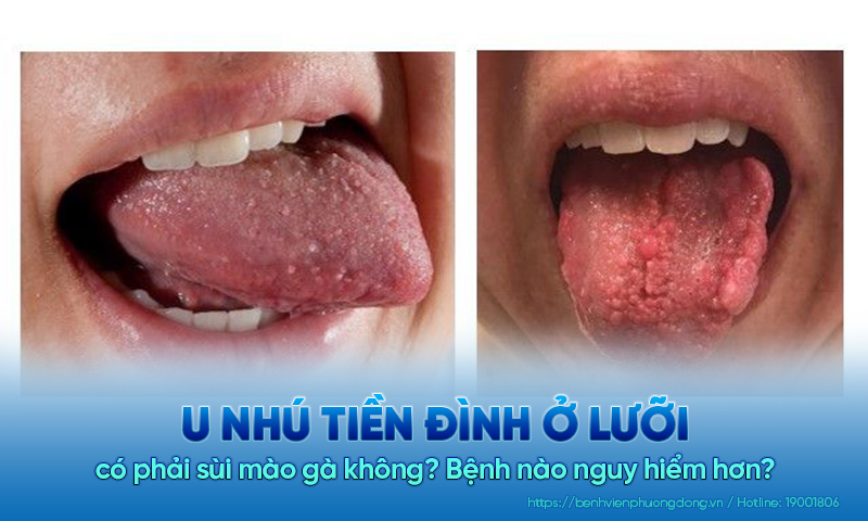 U nhú tiền đình ở lưỡi có phải sùi mào gà không? Bệnh nào nguy hiểm hơn?