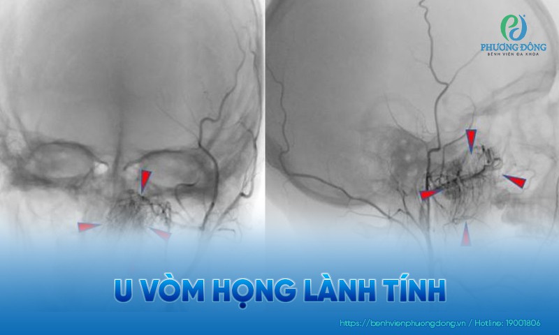 U vòm họng lành tính: Phân loại, chẩn đoán và phòng ngừa