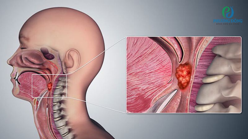 U vòm họng tổng hợp không gây đau hoặc loét họng