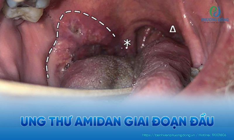 Ung thư amidan giai đoạn đầu: Nguyên nhân, triệu chứng và điều trị