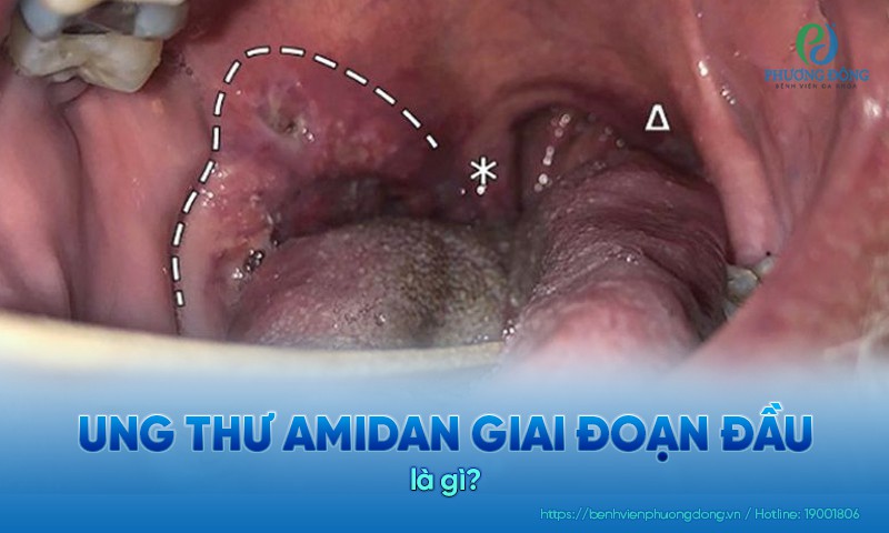 Ung thư amidan giai đoạn đầu chưa gây hại đến sức khỏe người bệnh