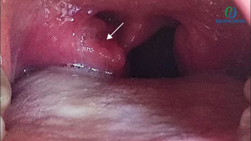 Dấu hiệu nhận biết ung thư amidan giai đoạn 1