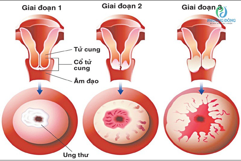 Hiểu đúng về sàng lọc ung thư cổ tử cung
