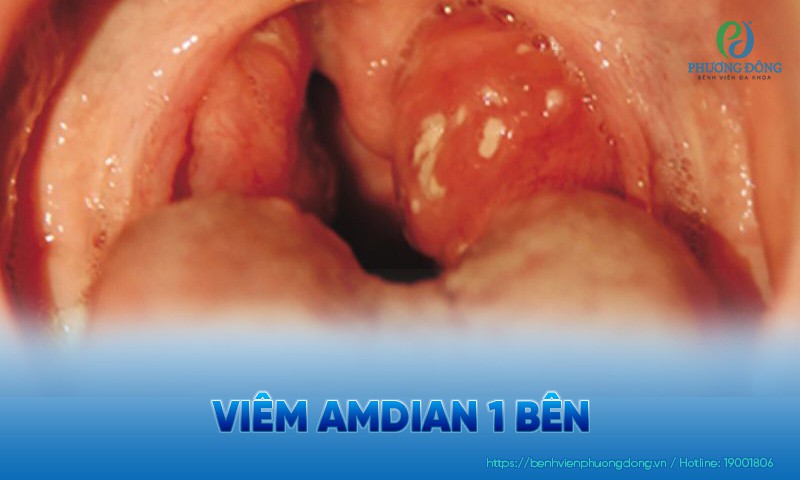 Viêm amidan 1 bên: Triệu chứng, nguyên nhân và hướng điều trị