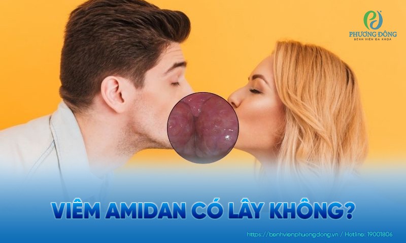 Viêm amidan có lây không? Phòng ngừa lây nhiễm amidan