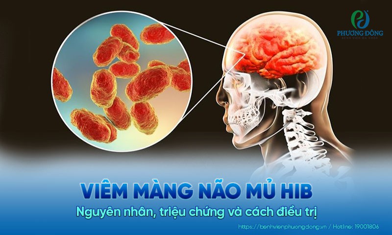 Viêm màng não mủ Hib: Nguyên nhân, triệu chứng và cách điều trị