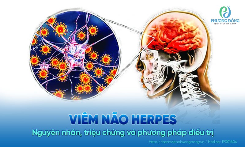 Viêm não Herpes: Nguyên nhân, triệu chứng và phương pháp điều trị