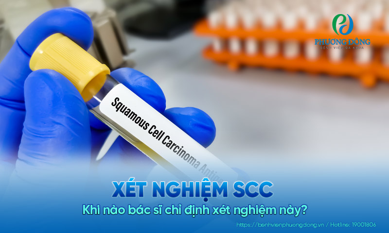Xét nghiệm SCC để làm gì? Khi nào bác sĩ chỉ định xét nghiệm này?